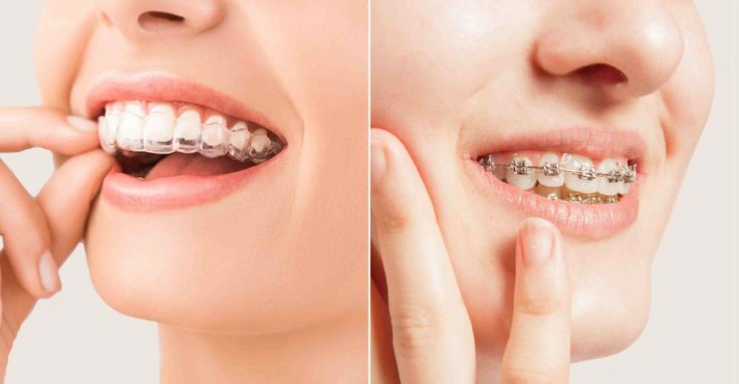 Invisalign vs Braces